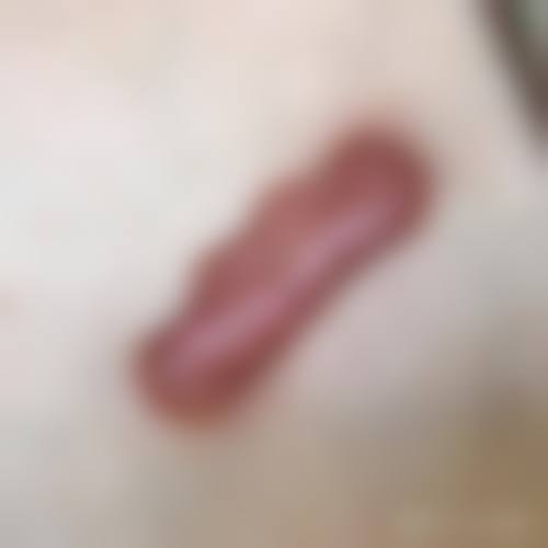 疤痕增生手术切除修复期多久？有哪些注意事项？