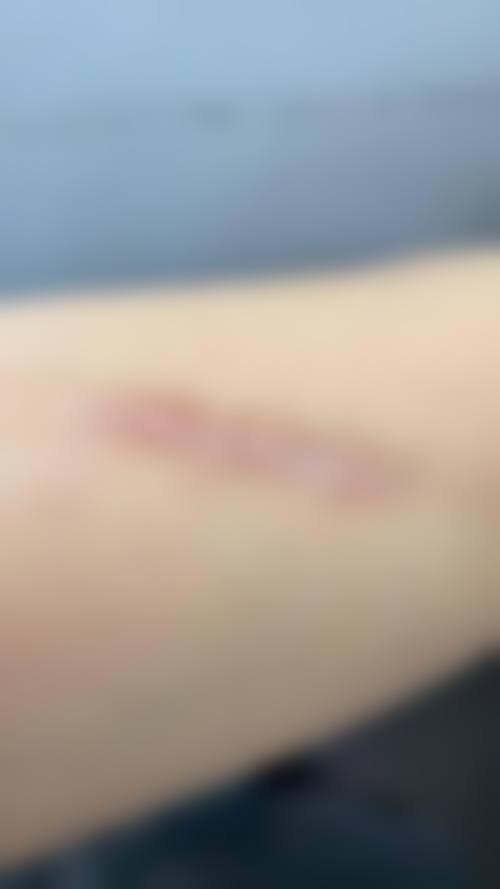 疤痕增生修复怎么选择医院医生及国内医院医生推荐