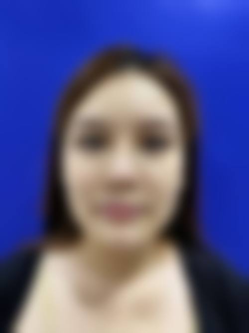 自体脂肪隆鼻常见认知偏差与误解