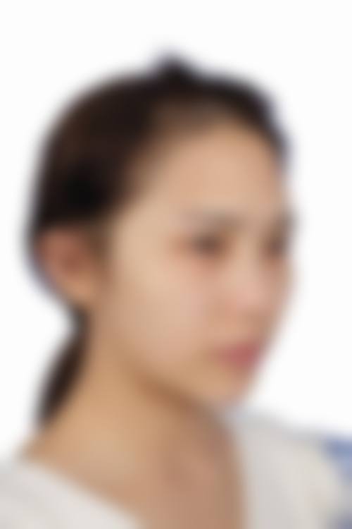 从医学角度看，自体脂肪隆鼻的风险主要集中在哪些环节？