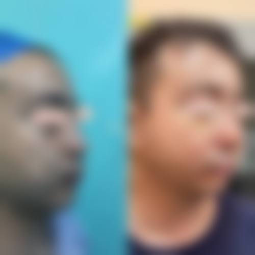 自体脂肪隆鼻本身能解决什么、不能解决什么？