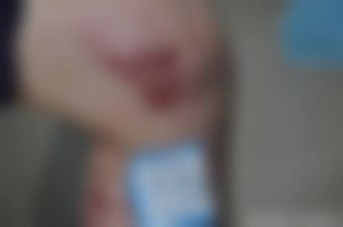 余百年疤痕凝胶和其他疤痕凝胶相比，优势在哪？