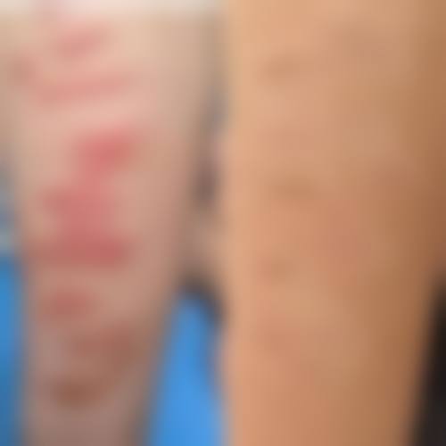 如何为眉毛伤疤痕治疗设定一个合理且可验证的成效目标