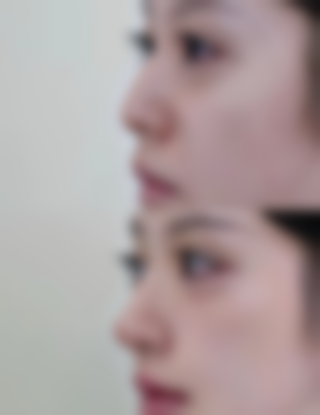 3D立体隆鼻的成分及作用机制在体内的具体过程