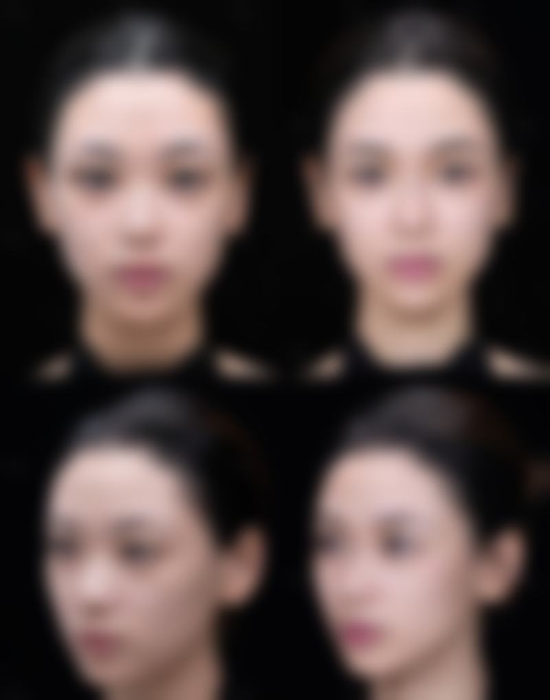 3D立体隆鼻机制在哪些情况下容易失效或打折