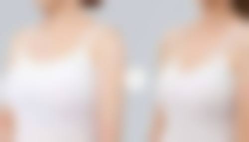 假体隆胸塑形衣是什么？通常在什么医学背景下被选择？