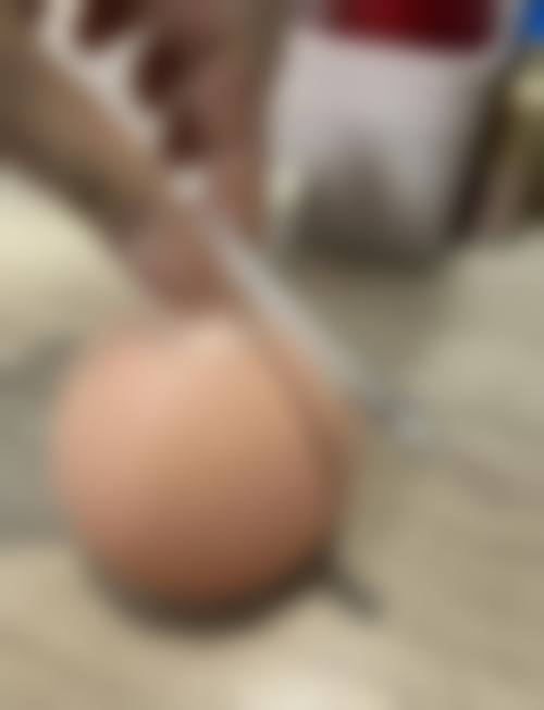 从医学角度看，假体隆胸塑形衣的风险主要集中在哪些环节？