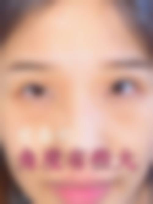 睡眠好了眼袋会消失吗？3种情况告诉你真相，附2026最新激光祛眼袋价格