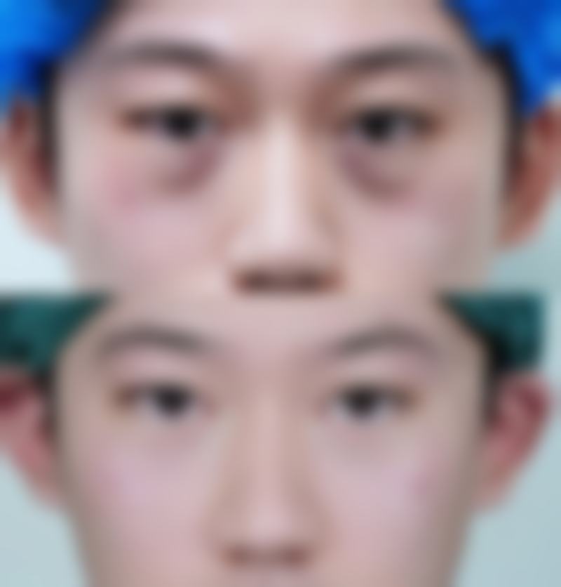 眼袋手术或治疗成效能维持多久？