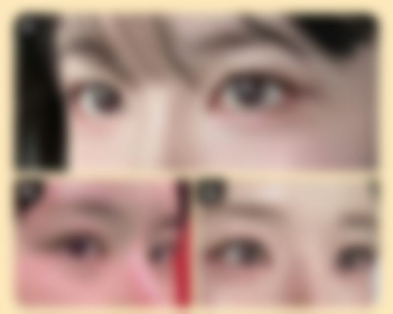 冬瓜可以消眼袋吗通常在什么阶段被纳入医疗选择范围?