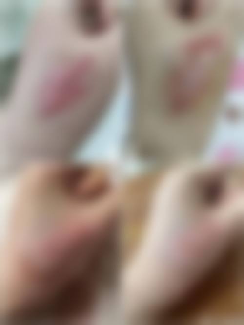 激光祛疤祛儿童手术疤痕成效如何?