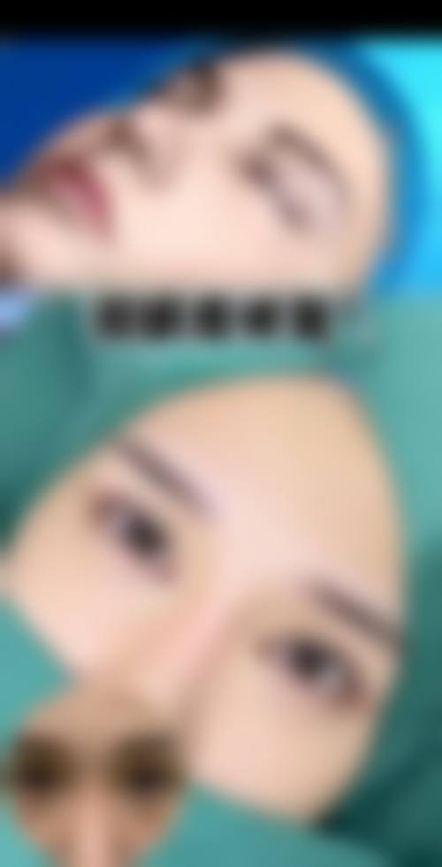 去眼袋后淤青怎么下去的快？冷热敷+药物辅助7天见效，协和医生亲授消肿秘籍