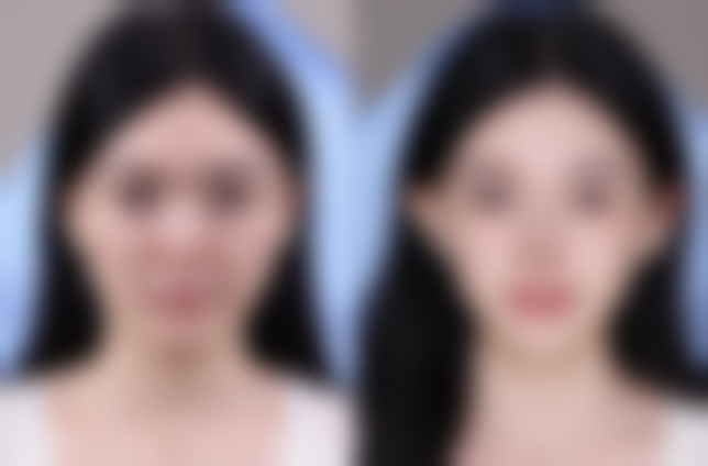 去眼袋手术的价格区间及费用差异来源