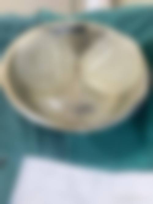 假体隆胸包膜挛缩揭秘