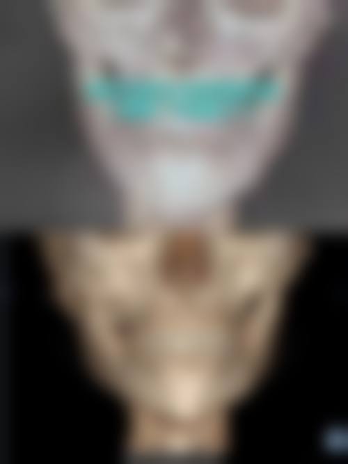 下颌骨整形可以医保吗？2026最新报销政策解析：功能性矫正可报3-8万，美容项目需自费！