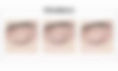 双眼皮二次修复好吗？苏州陈光医生95%成功率，1.5万起重塑自然美眸