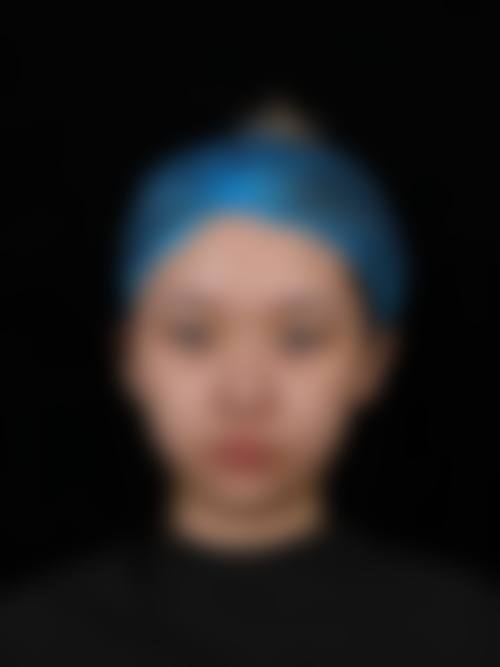 双眼皮二次修复手术或治疗成效能维持多久？