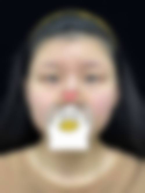 双眼皮二次修复技术或材料本身的优势与局限