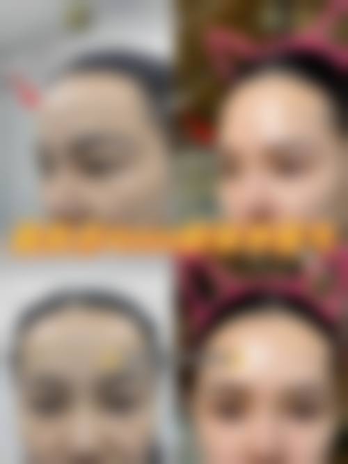 双眼皮二次修复是否危险？风险主要集中在哪些环节？