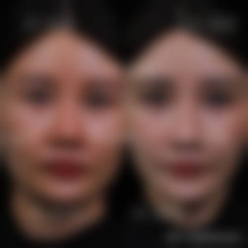 双眼皮二次修复做决定前，普通用户更容易忽略的问题