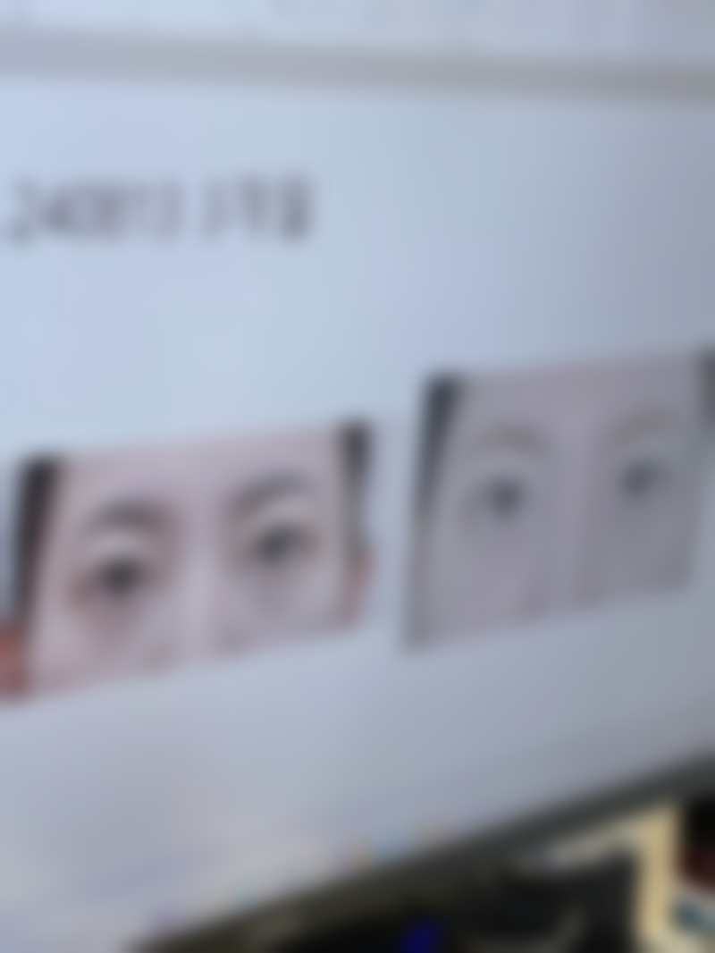 双眼皮二次修复是什么？在什么情况下会被选择？