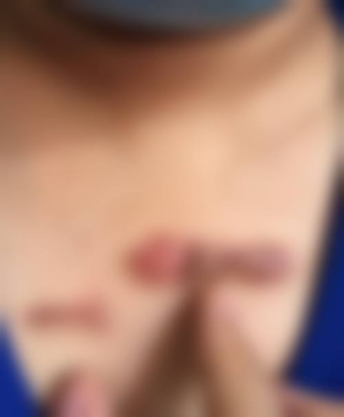 腋下疤痕多久消失