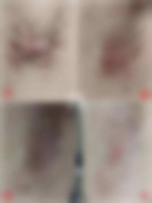 腋下疤痕疙瘩去除手术成效如何