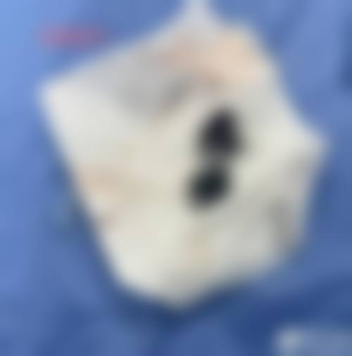 避坑与建议:奥美定隆鼻及取出实操