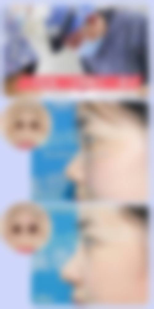 注射隆鼻会不会有后遗症：长期留存的“隐形麻烦”