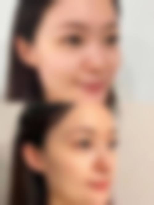 注射隆鼻有什么风险：那些容易被忽略的后遗症