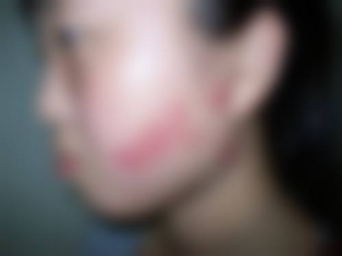 凹陷和凸起疤痕修复的不同原理