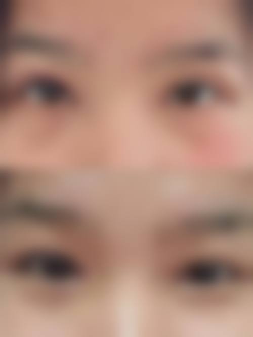 韩式定位双眼皮是恒久性的吗