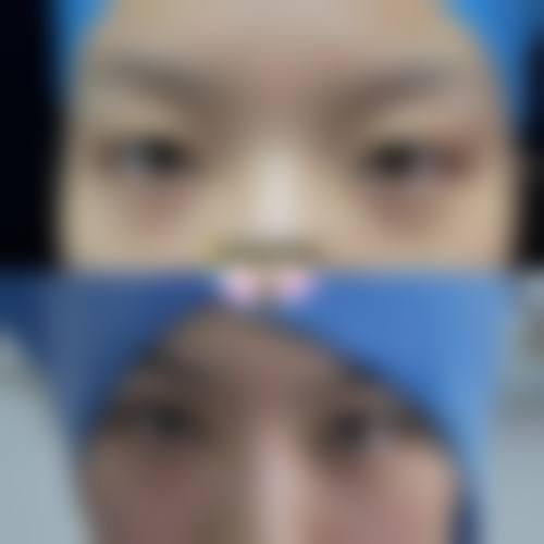 韩式定位双眼皮需要拆线吗