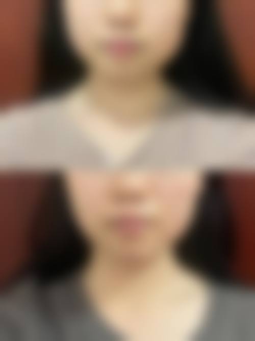 瘦脸针的费用是多少