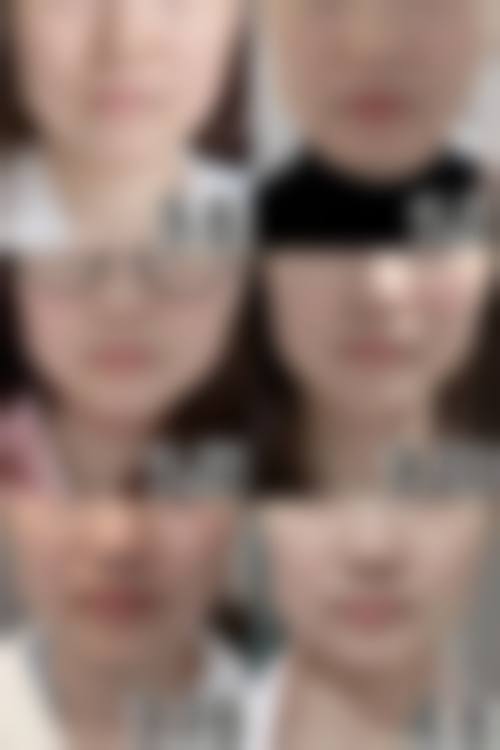 打多少次瘦脸针能接近“恒久”成效