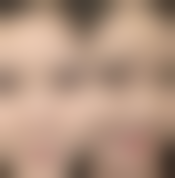 韩式定位双眼皮怎么做，多久恢复自然？和埋线哪个好？附2980元14天恢复案例