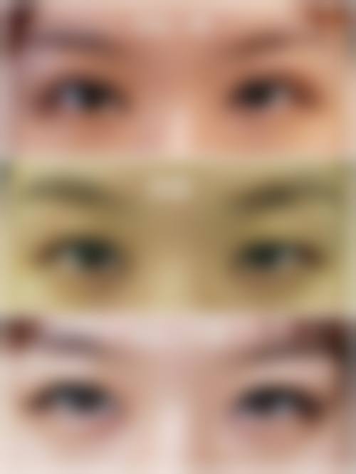 做双眼皮只开眼角可以吗多少钱?3000 - 6000元的价格明细