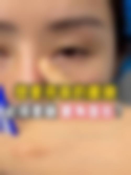 激光治疗能有效改善男生眼袋吗?