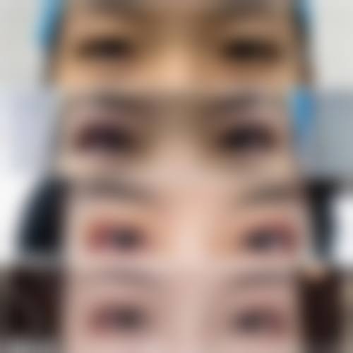 做双眼皮只开眼角可以吗？当然行！单独开眼角3000 - 6000元，效果实例为你揭秘 