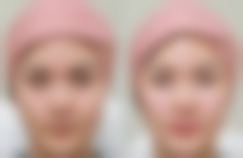 超声治疗对男生眼袋有成效吗?