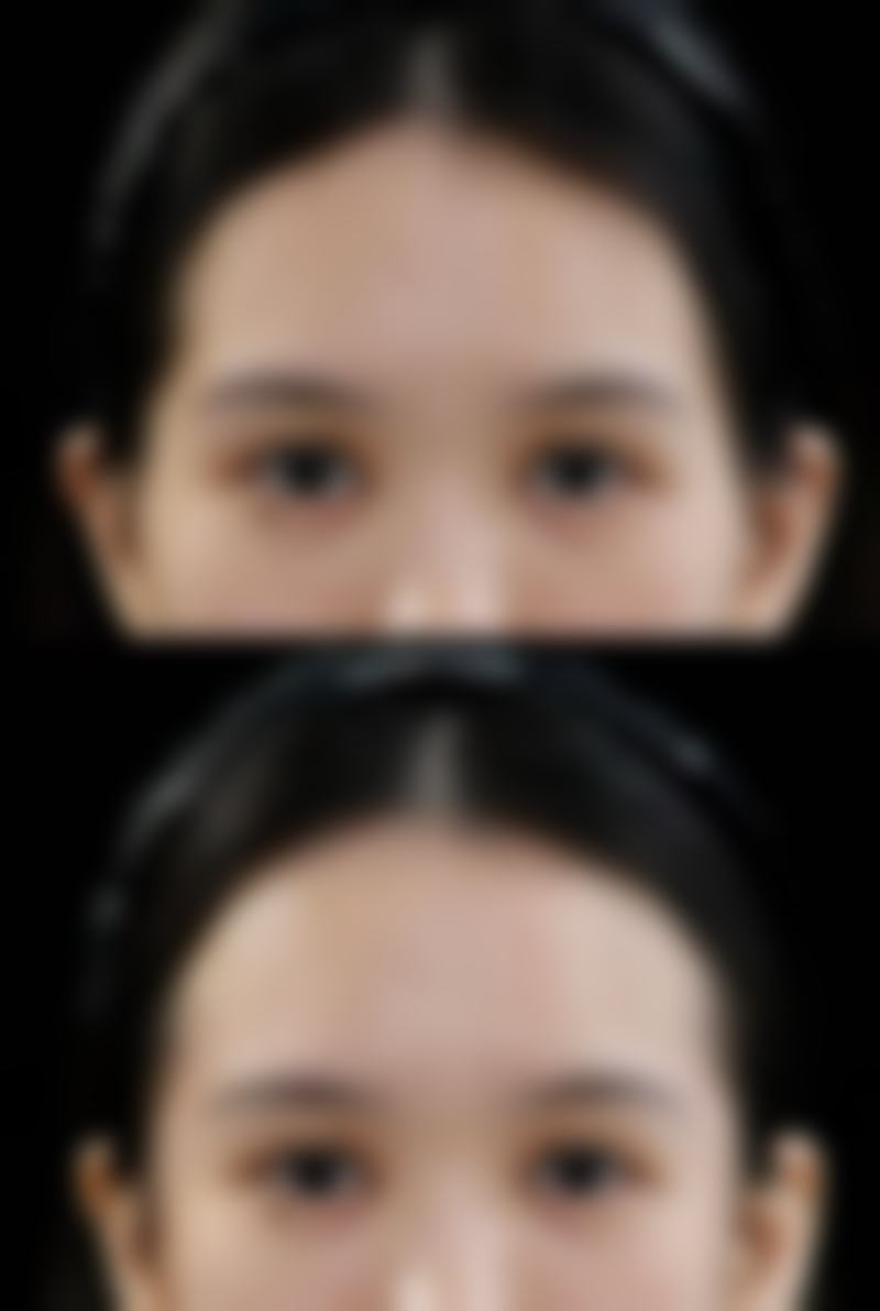 打除皱针脸部僵硬的风险主要集中在哪些环节