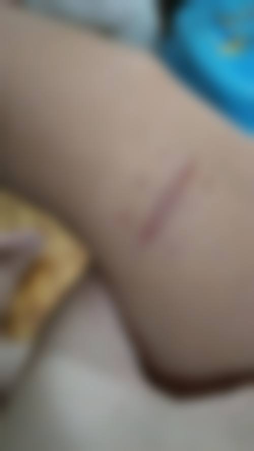 小孩脸上磕破了会留疤痕吗？表皮擦伤消毒后不留疤，附无疤处理+修复攻略