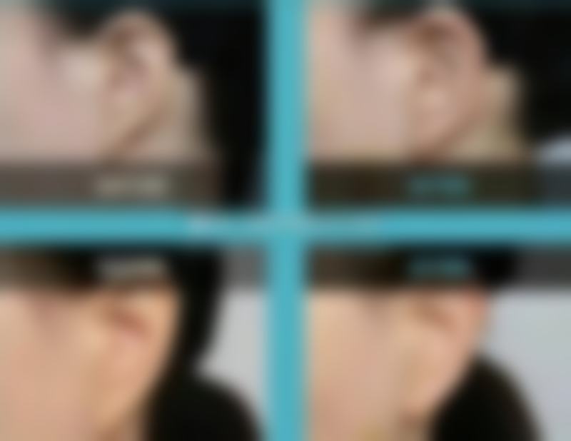 疤痕妊娠流产的至佳治疗方案