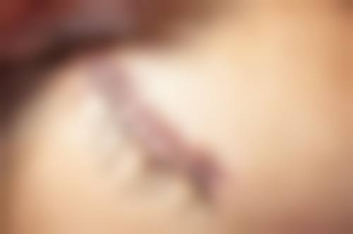 疤痕疙瘩可以完全消除吗？