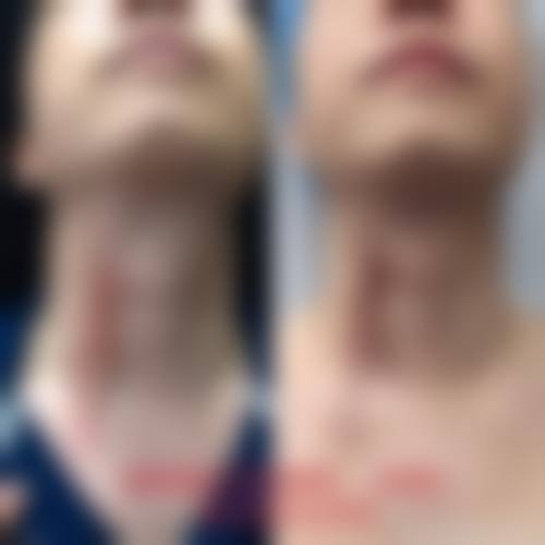 疤痕疙瘩治疗怎么选择医院医生及国内医院医生推荐？