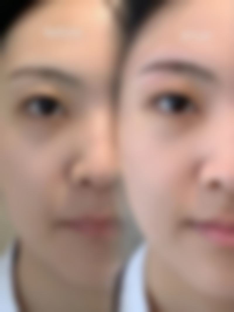 热敷按摩：简单低成本，能否搞定脂肪粒？