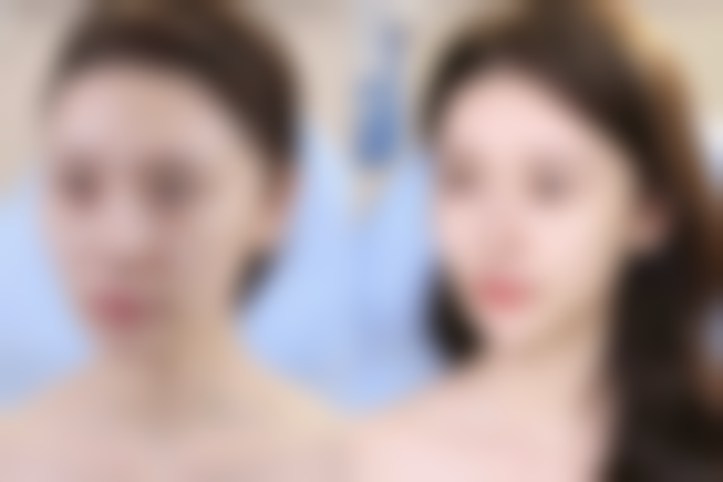 真人实例成效：他们是如何告别脂肪粒的？