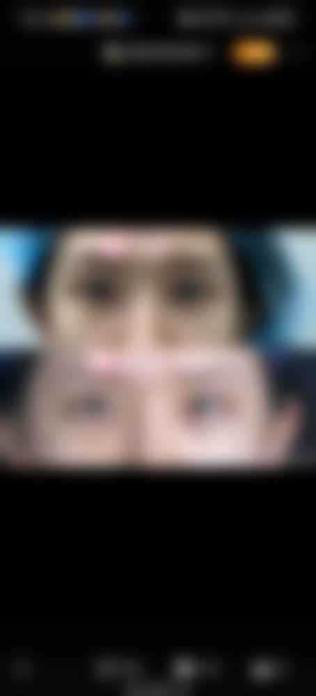 做了埋线双眼皮可以开眼角吗？答案是肯定的！眼裂放大更美观，1-3个月恢复+护理指南