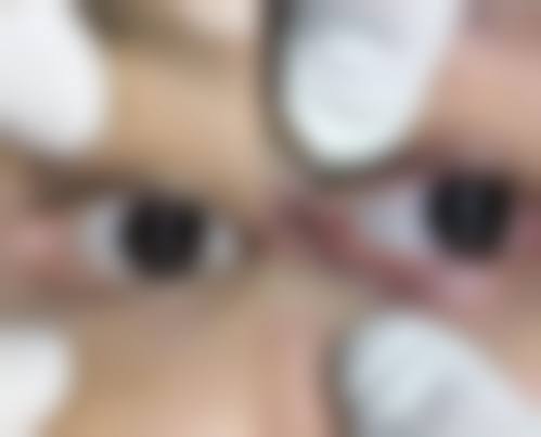 做了埋线双眼皮开眼角的护理指南