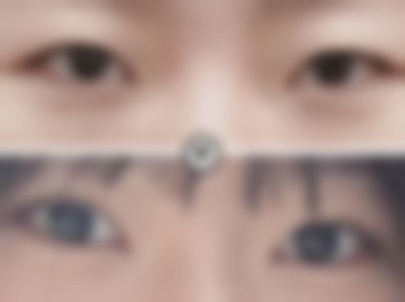 做双眼皮埋的线常见材质的安心性对比